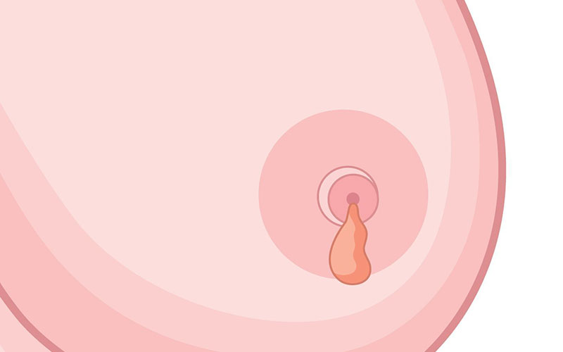 Symptoms of Breast Cancer