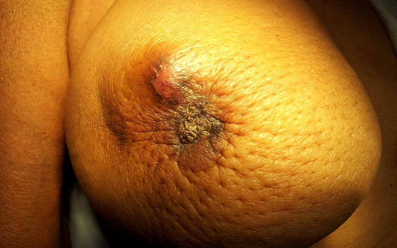 Symptoms of Breast Cancer