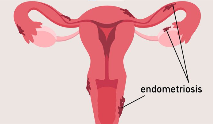 endometriosis.jpg
