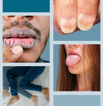 ඔබට යකඩ ඌණතාවය ඇතිබව පෙන්වන ලක්ෂණ මොනවද දන්නවද?