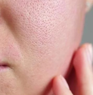 Open Pores වලට මොනවද කරන්න පුළුවන්?