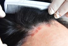 කොච්චර පිරිසිදු වුණත් පස්සෙන් එන Psoriasis