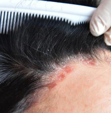 කොච්චර පිරිසිදු වුණත් පස්සෙන් එන Psoriasis