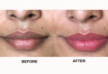 රස්නේ කාලෙට වියළීමට ලක් වෙන දෙතොල් වලට විශේෂිත ප්රතිකාරයක්