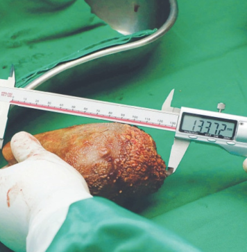 ලොව විශාලතම වකුගඩු ගල ලංකාවෙන්!