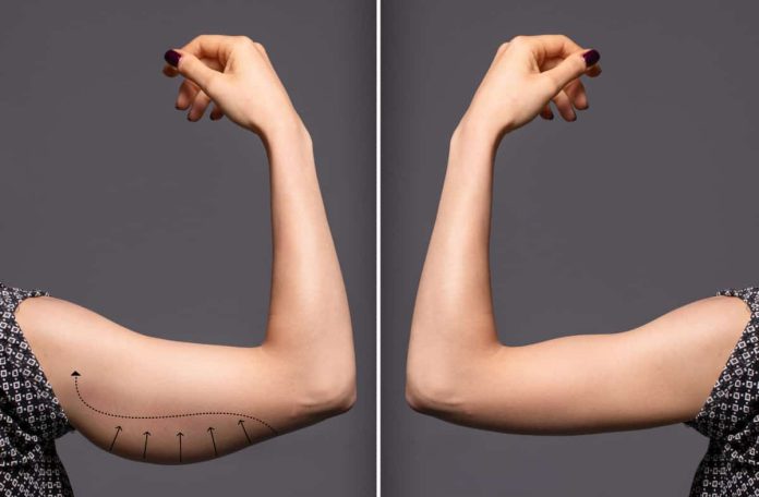 before-and-after-flabby-arms.jpg
