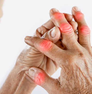 ආතරයිටීස් ගැන ඔබ දැන සිටිය යුතුම කරුණු 10 ක්..