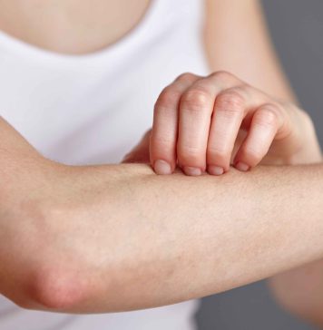 දහඩිය බිබිලි සුව කරන ස්වභාවික අමුද්රව්ය ගැන ඔබ දන්නවද?