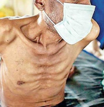 යළි හිස ඔසවන ‘ක්ෂය රෝගය’