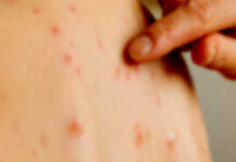 සරම්ප රෝගීන් දෙදෙනෙක් කොළඹින් හමුවෙයි – අනිවාර්යයෙන් එන්නත් ලබාගන්නැයි උපදෙස්