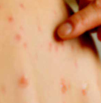 සරම්ප රෝගීන් දෙදෙනෙක් කොළඹින් හමුවෙයි – අනිවාර්යයෙන් එන්නත් ලබාගන්නැයි උපදෙස්